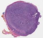 tumor’s solid growth pattern