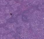 lymphoid