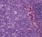 large pleomorphic tumor cells