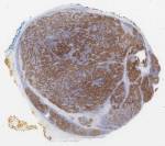 large pleomorphic cells