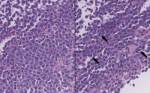 The large atypical cells