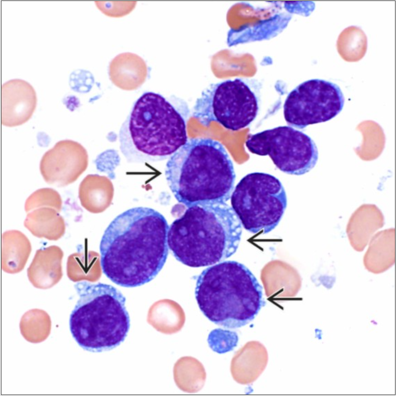 The cytoplasm in the neoplastic cells may contain perinuclear vacuoles