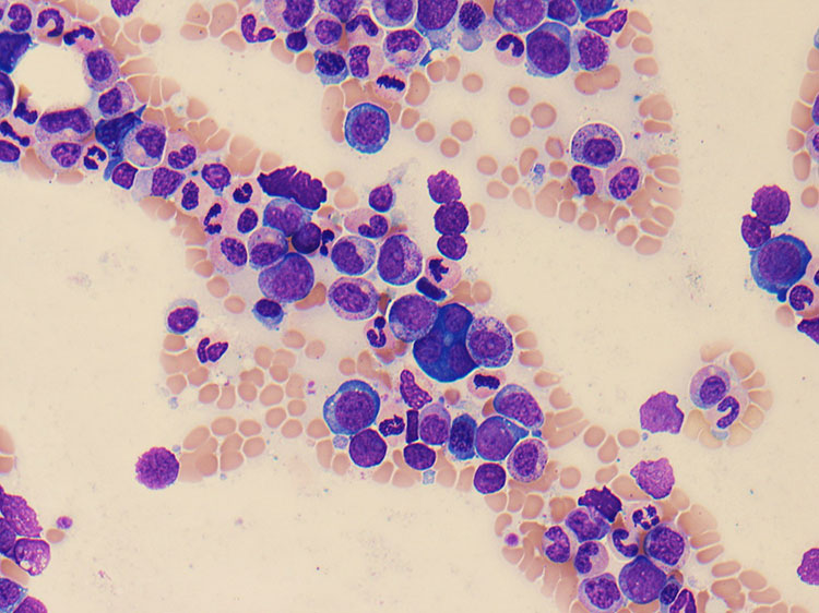 Giemsa, aspirate smear (500x)