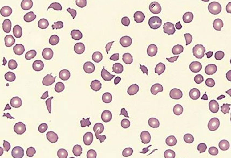 Peripheral Blood Smear