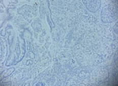 Canal Immunohistochemistry GCDFP-15