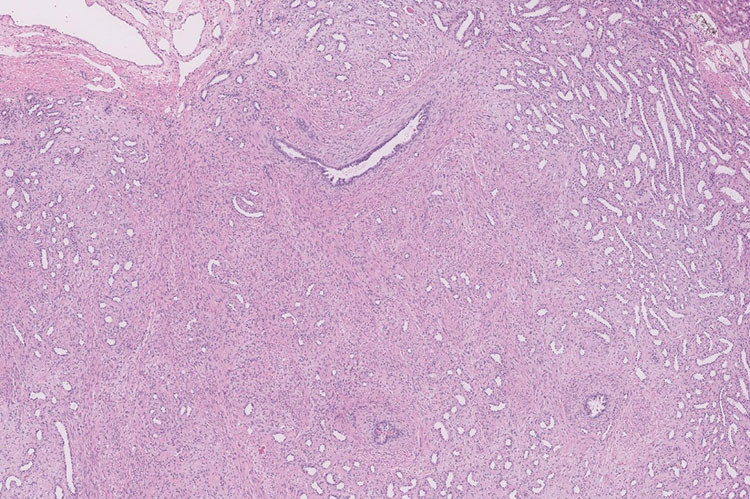 Figure 2. Immature tubules with surrounding collarette of spindle cell stroma (10x, 4x).