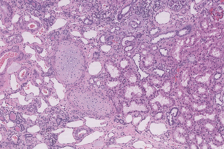 Figure 3. Focal islands of cartilage are present (H&E, 10x)