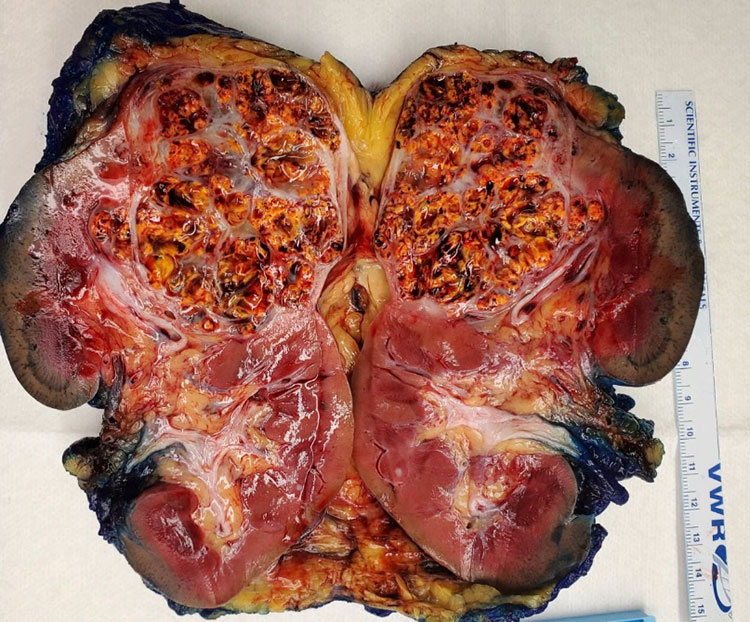 Gross examination of the kidney