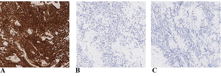 Figure 2 IHC, 100x. A, GFAP. B, EMA. C Ki67.