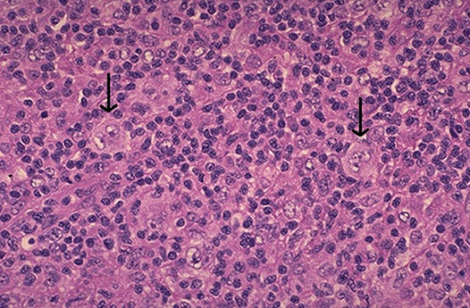 lymph node and bone marrow biopsy