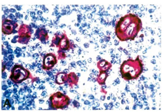 CD30: Membrane and cytoplasm staining