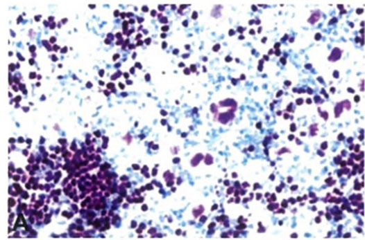 PAX5: Stains the nuclei of these cells weakly