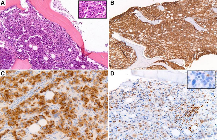 Hodgkin’s lymphoma