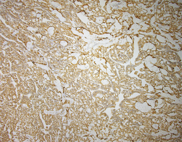 Figure 5. GFAP Immunohistochemistry.