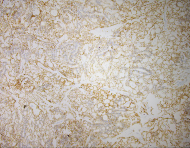 Figure 6. S100 Immunohistochemistry.