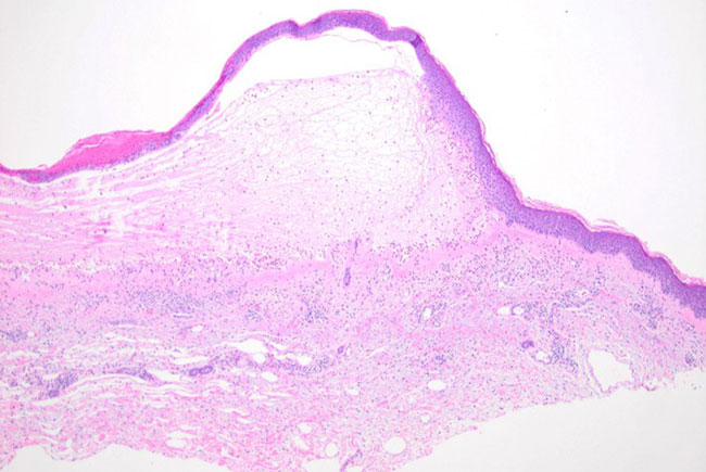 Subepidermal split between the epidermis and the dermis