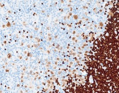 immunohistochemical stains supporting CHL diagnosis