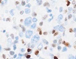 immunohistochemical stains supporting CHL diagnosis