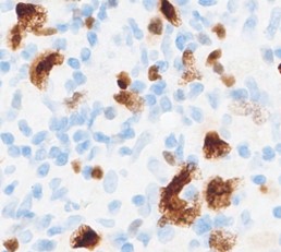 immunohistochemical stains supporting CHL diagnosis