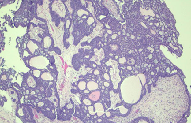 Biopsies of the sinonasal mass