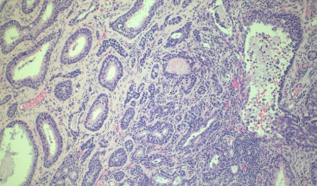 Biopsies of the sinonasal mass