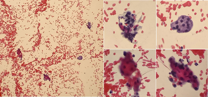 FNA of parotid