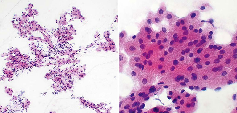 Oncocytoma showing branching cords of proliferating oncocytes