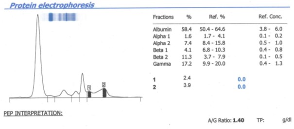 Analysis of Plasma Sample via Protein Electrophoresis (PEP)