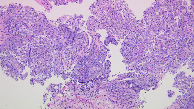 Liver, right lobe mass biopsy 100x