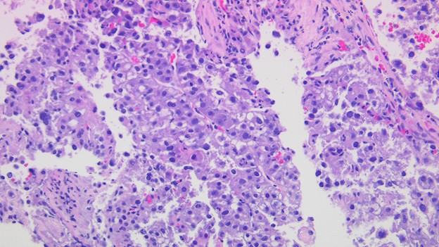 Liver, right lobe mass biopsy 200x