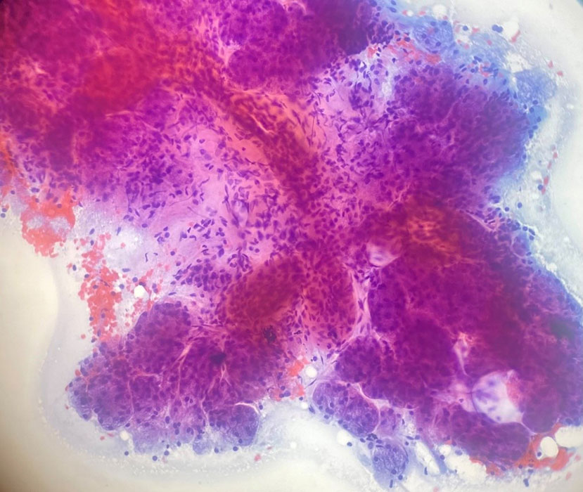 Aspirate smear, Papanicolaou (PAP) stain