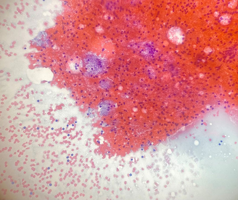 Aspirate smear, Papanicolaou (PAP) stain