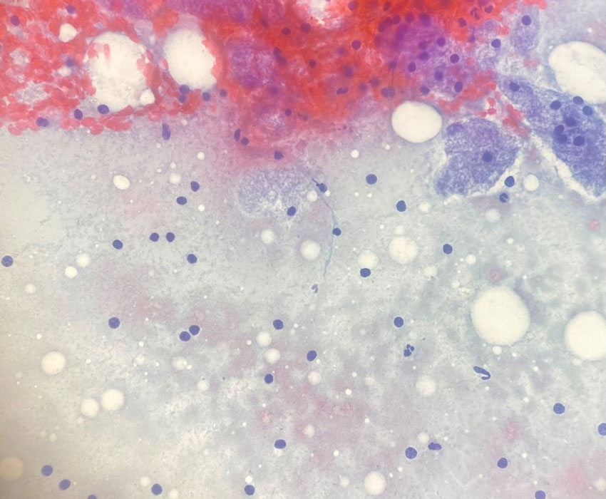 Aspirate smear, Papanicolaou (PAP) stain