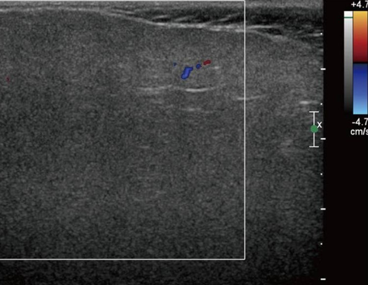 No evidence of increased blood flow