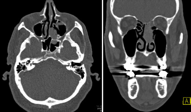 Left anterior skull base