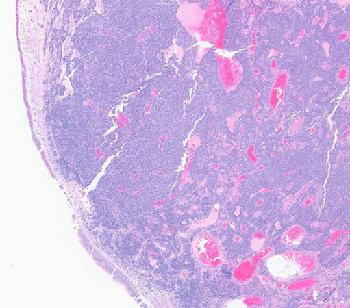 Histologic sections of the resection