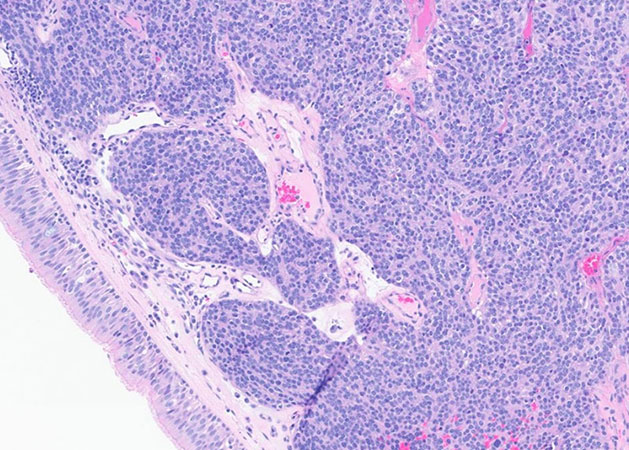 Histologic sections of the resection