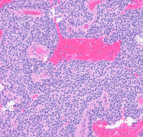 Histologic sections of the resection