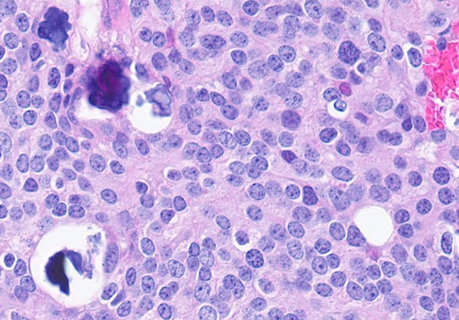 Histologic sections of the resection