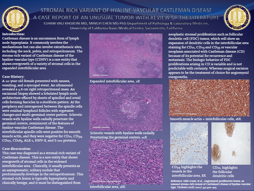 Stromal_Rich_Castleman_Disease_poster_ValiKhojeini