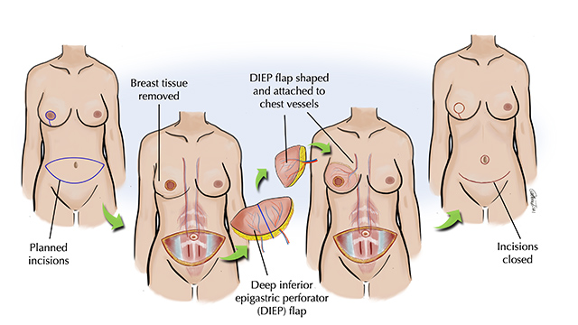 DIEP Flap diagram