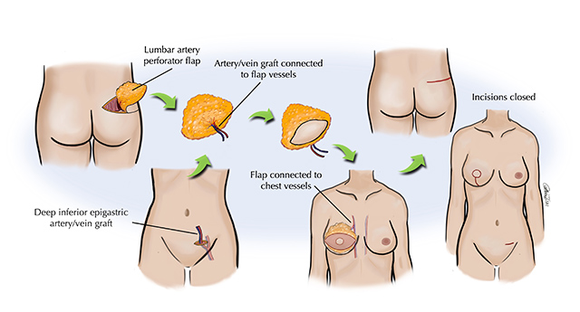 LAP Flap diagram