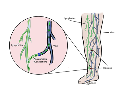 Lymphovenous Bypass (LVB) surgery