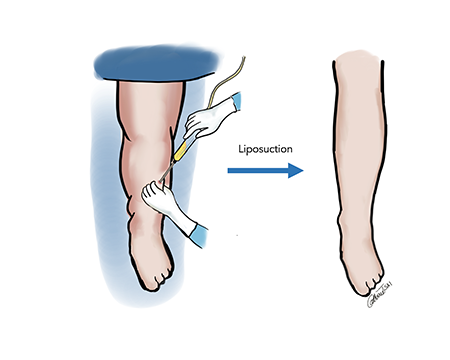 Suction-Assisted Protein Lipectomy (SAPL)