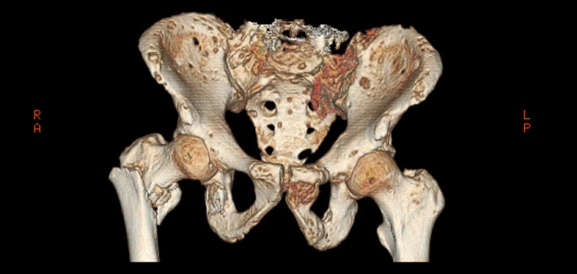 Risk and safety during your CAT Scan 