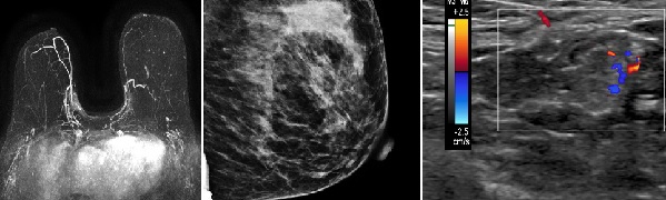 Breast Imaging