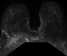 Breast Stereotactic