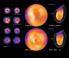 NM Cardiac Stress