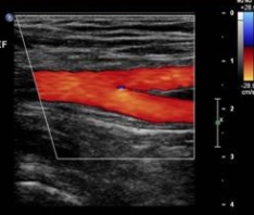 Peripheral Arterial Duplex