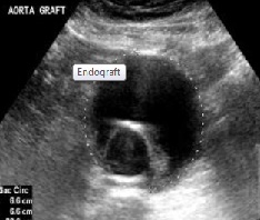 Aortic Graft